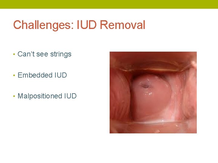 Challenges: IUD Removal • Can’t see strings • Embedded IUD • Malpositioned IUD 