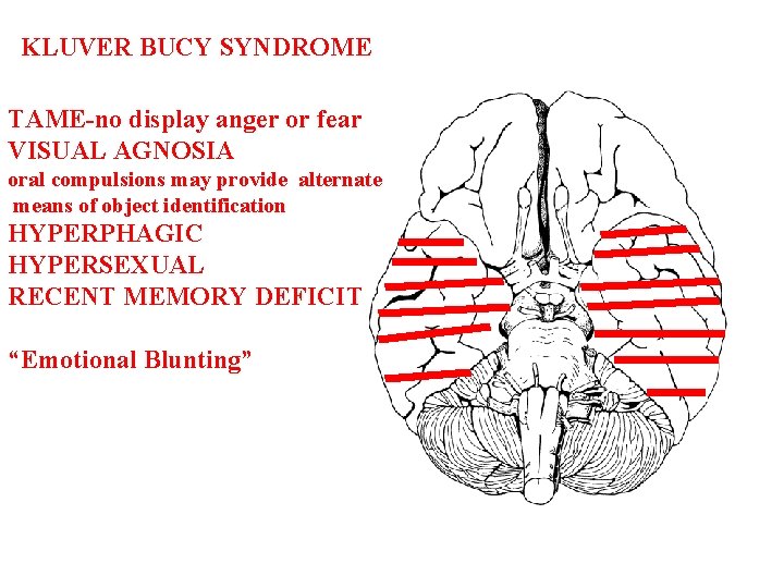 KLUVER BUCY SYNDROME TAME-no display anger or fear VISUAL AGNOSIA oral compulsions may provide