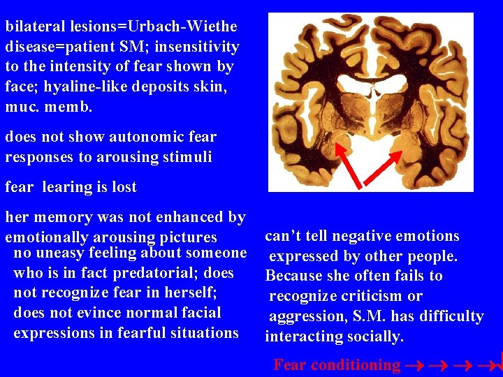bilateral lesions=Urbach-Wiethe disease=patient SM; insensitivity to the intensity of fear shown by face; hyaline-like