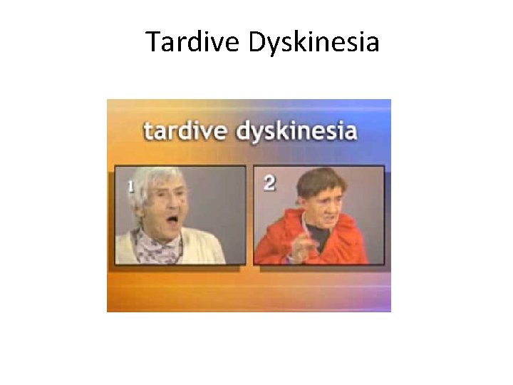 Tardive Dyskinesia 