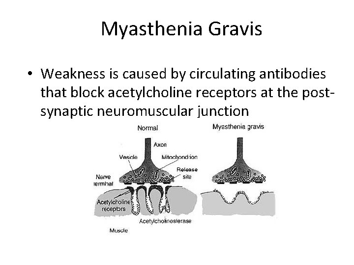 Myasthenia Gravis • Weakness is caused by circulating antibodies that block acetylcholine receptors at