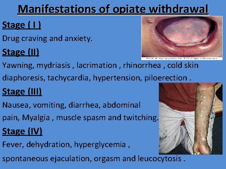 Manifestations of opiate withdrawal Stage ( I ) Drug craving and anxiety. Stage (II)