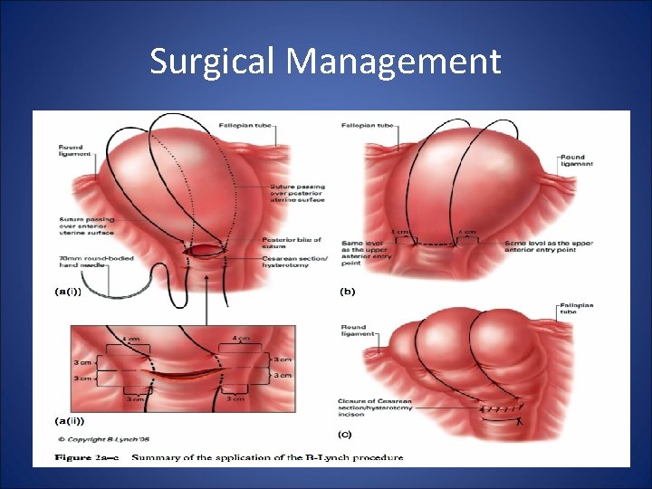 Surgical Management 