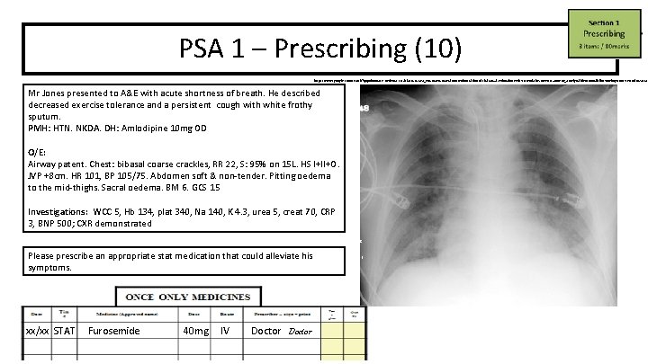 PSA 1 – Prescribing (10) https: //www. google. com/search? q=pulmonary+oedema+cxr&rlz=1 C 1 GCEA_en. GB