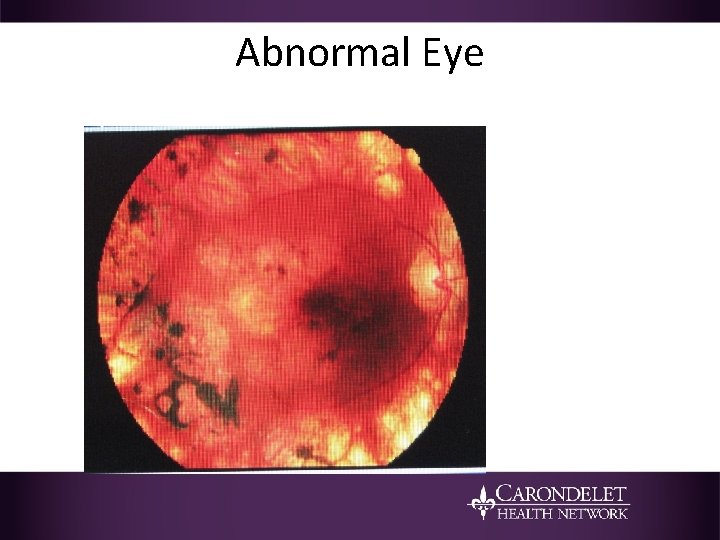 Abnormal Eye 