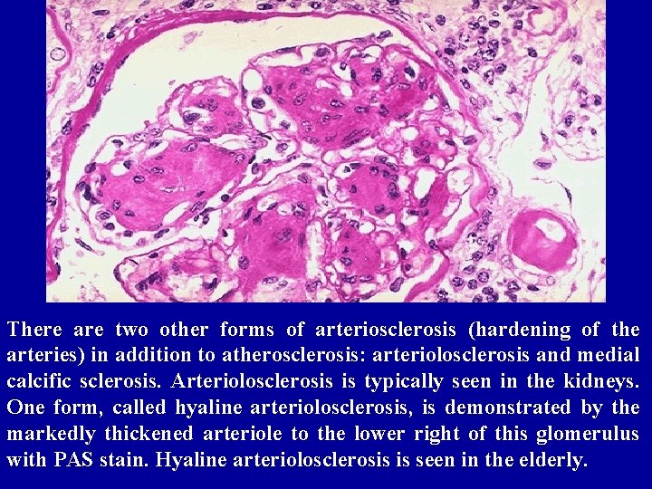 There are two other forms of arteriosclerosis (hardening of the arteries) in addition to