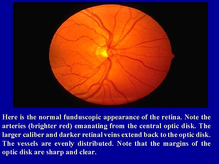 Here is the normal funduscopic appearance of the retina. Note the arteries (brighter red)