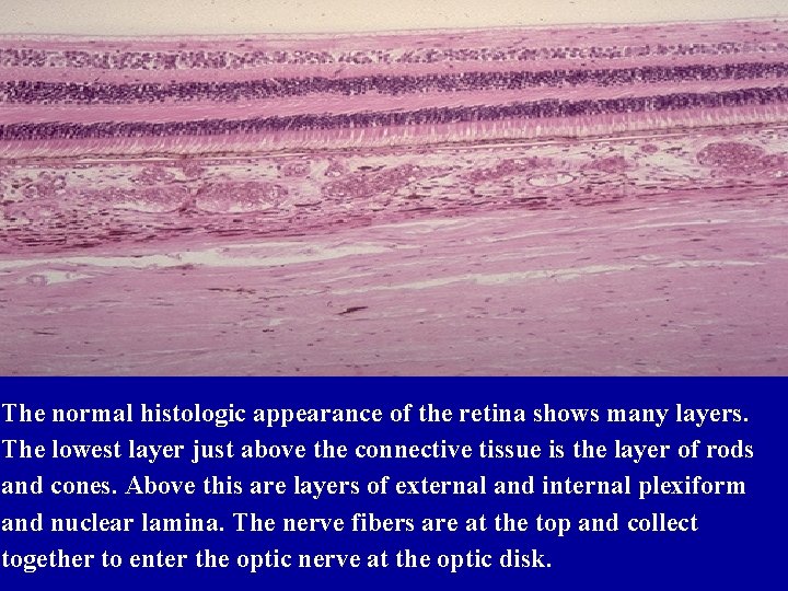 The normal histologic appearance of the retina shows many layers. The lowest layer just