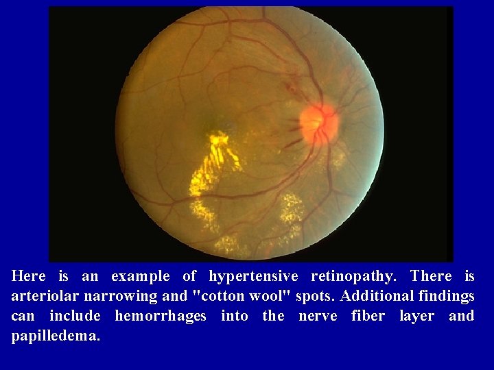 Here is an example of hypertensive retinopathy. There is arteriolar narrowing and "cotton wool"