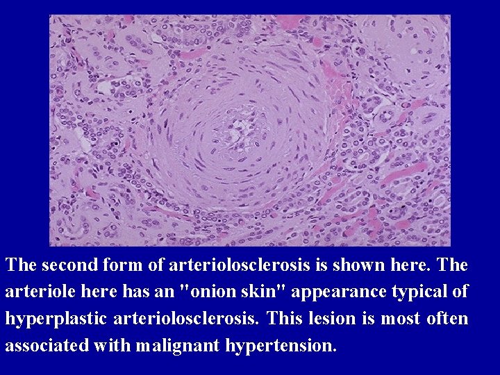 The second form of arteriolosclerosis is shown here. The arteriole here has an "onion