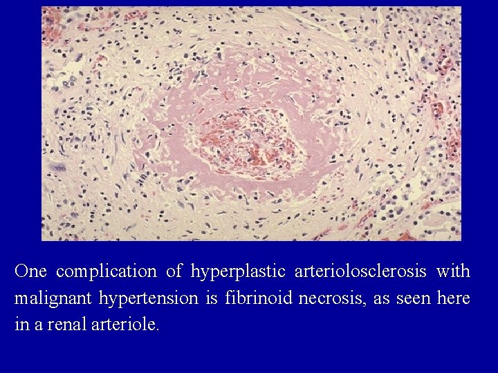 One complication of hyperplastic arteriolosclerosis with malignant hypertension is fibrinoid necrosis, as seen here