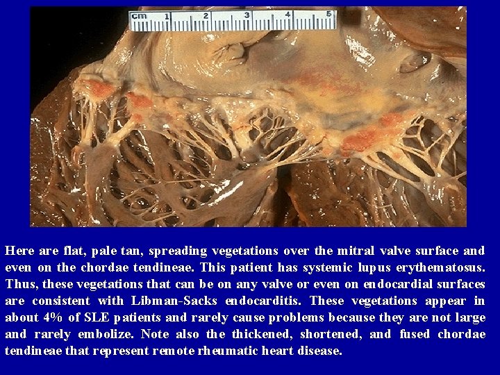 Here are flat, pale tan, spreading vegetations over the mitral valve surface and even