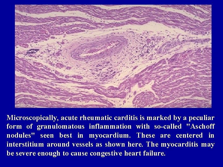 Microscopically, acute rheumatic carditis is marked by a peculiar form of granulomatous inflammation with