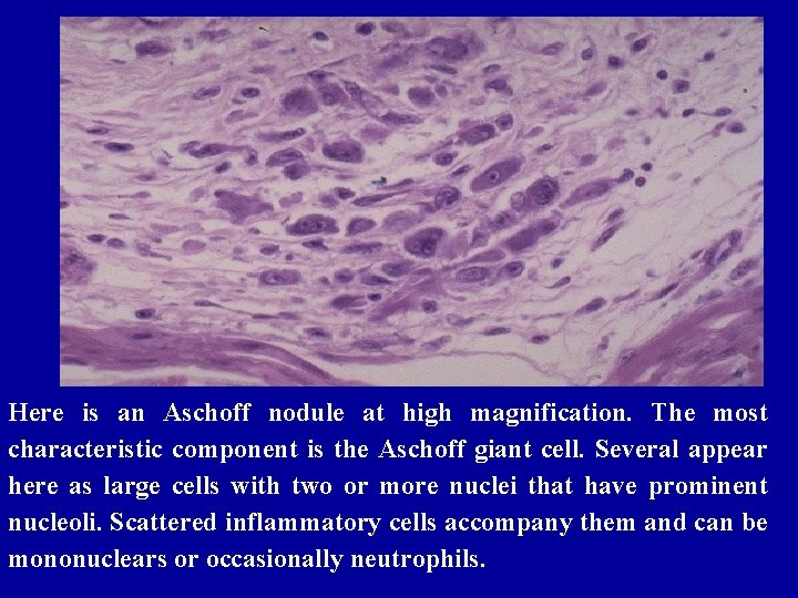 Here is an Aschoff nodule at high magnification. The most characteristic component is the