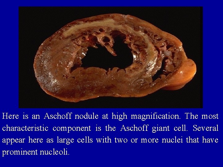 Here is an Aschoff nodule at high magnification. The most characteristic component is the