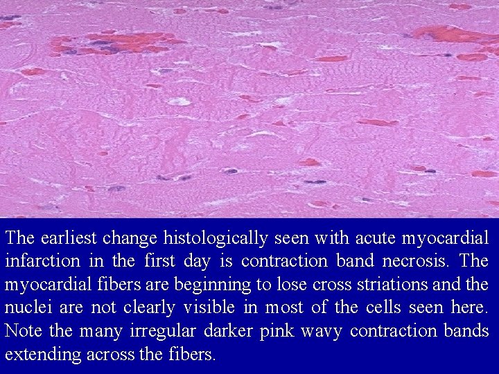 The earliest change histologically seen with acute myocardial infarction in the first day is