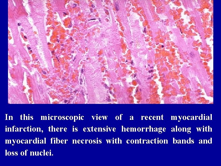 In this microscopic view of a recent myocardial infarction, there is extensive hemorrhage along