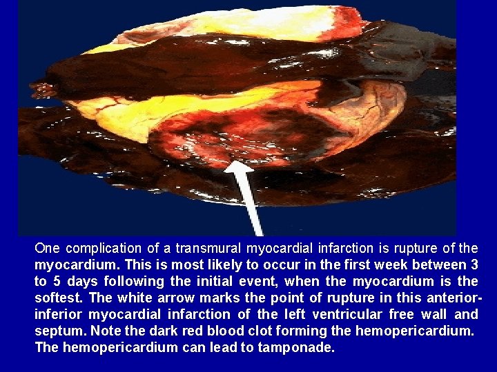 One complication of a transmural myocardial infarction is rupture of the myocardium. This is