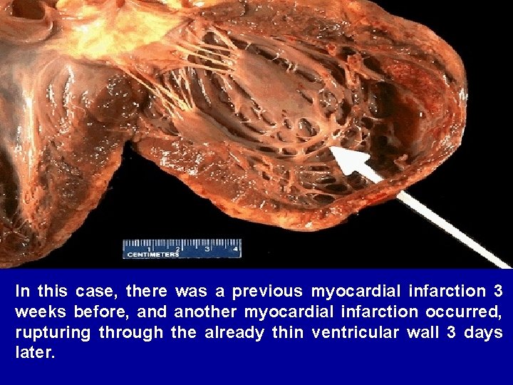 In this case, there was a previous myocardial infarction 3 weeks before, and another