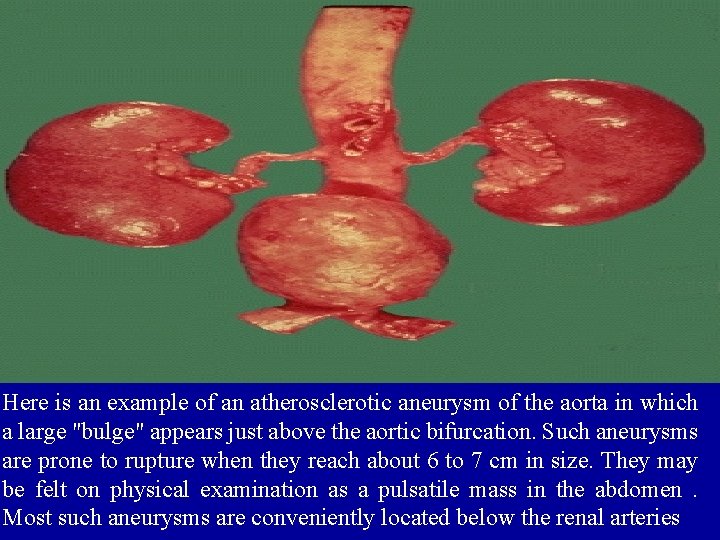 Here is an example of an atherosclerotic aneurysm of the aorta in which a