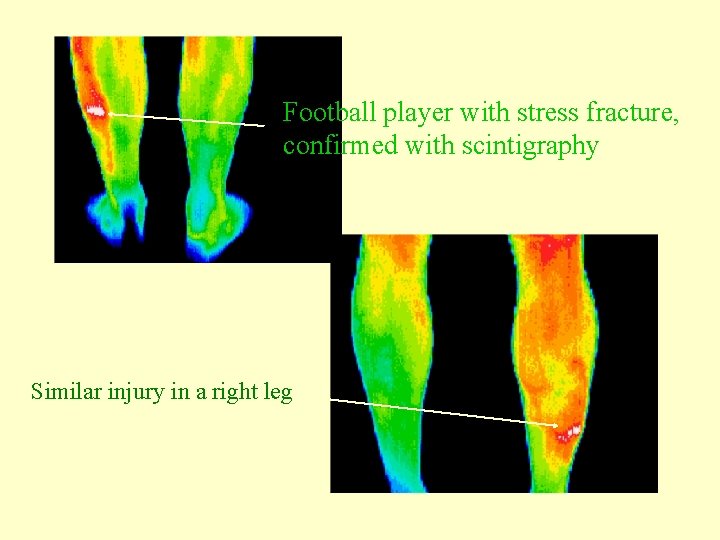 Football player with stress fracture, confirmed with scintigraphy Similar injury in a right leg