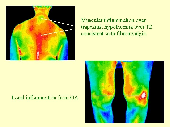 Muscular inflammation over trapezius, hypothermia over T 2 consistent with fibromyalgia. Local inflammation from