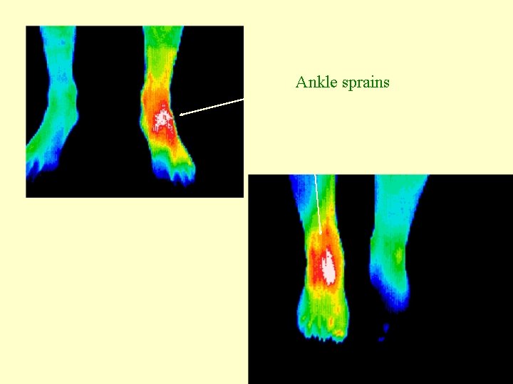 Ankle sprains 