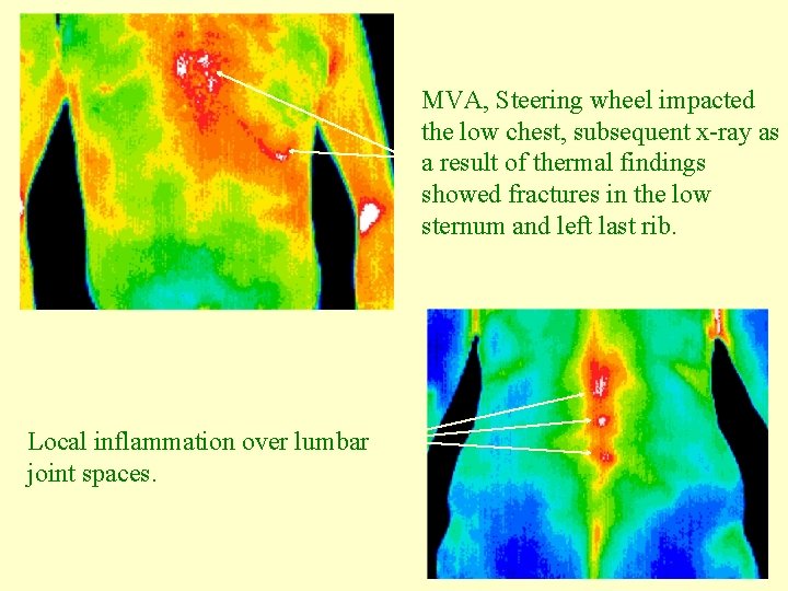MVA, Steering wheel impacted the low chest, subsequent x-ray as a result of thermal