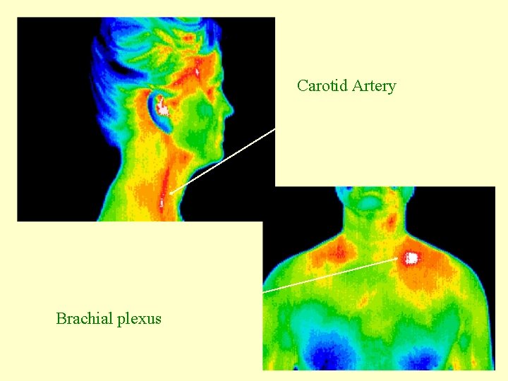 Carotid Artery Brachial plexus 