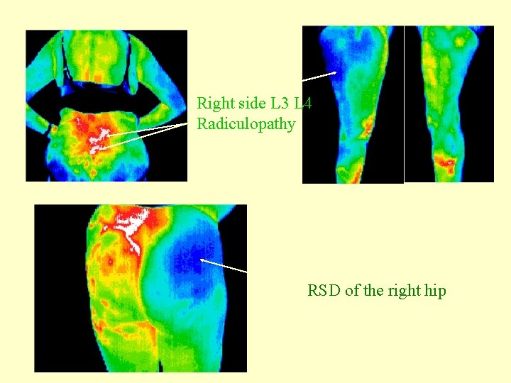 Right side L 3 L 4 Radiculopathy RSD of the right hip 