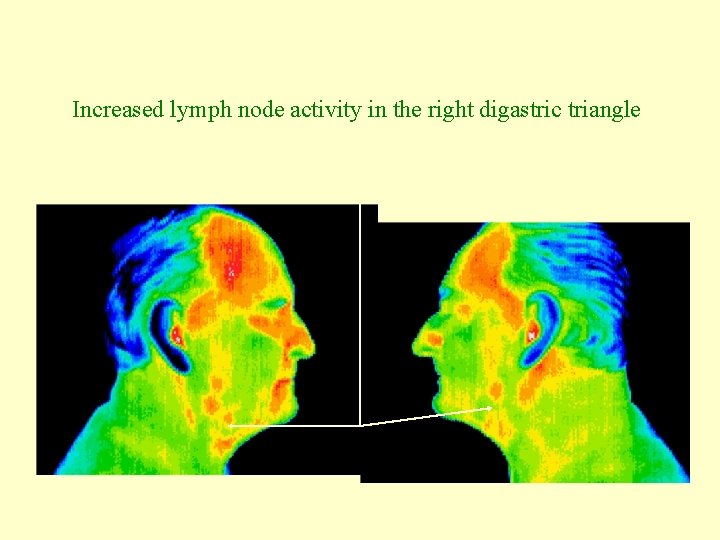Increased lymph node activity in the right digastric triangle 