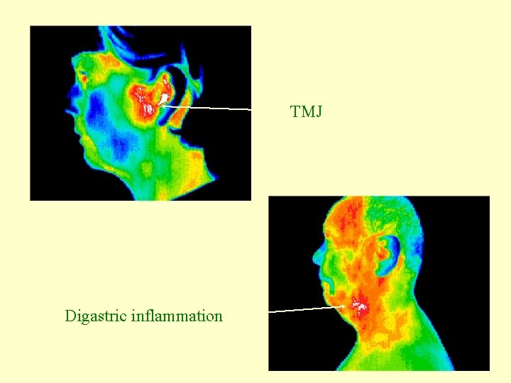 TMJ Digastric inflammation 