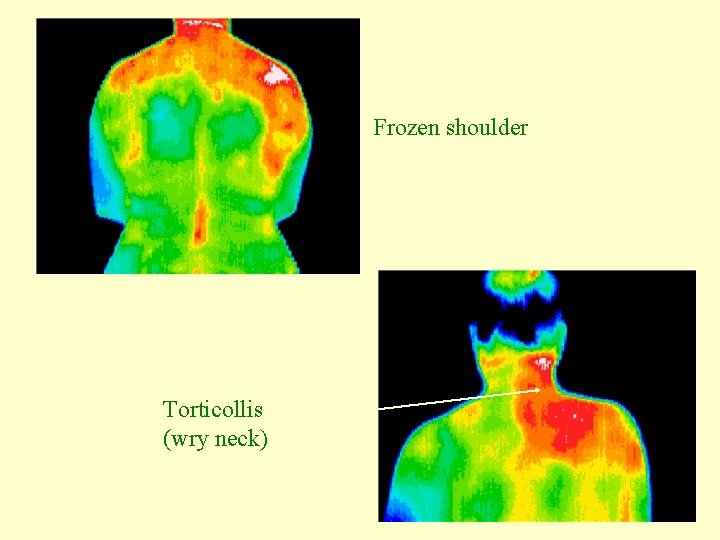 Frozen shoulder Torticollis (wry neck) 