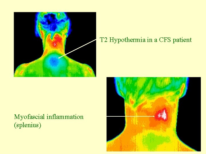 T 2 Hypothermia in a CFS patient Myofascial inflammation (splenius) 