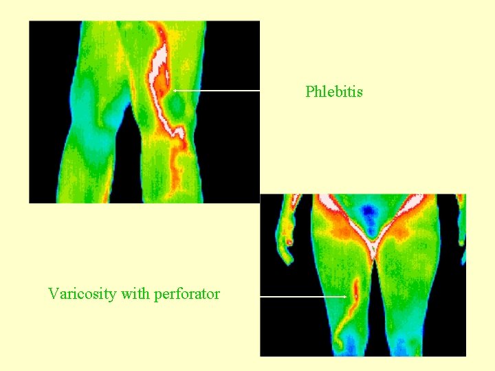 Phlebitis Varicosity with perforator 