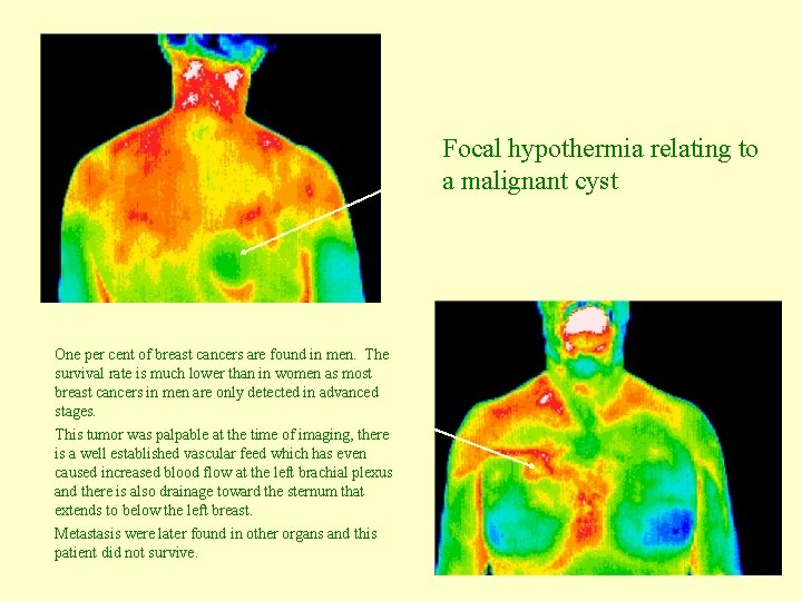 Focal hypothermia relating to a malignant cyst One per cent of breast cancers are