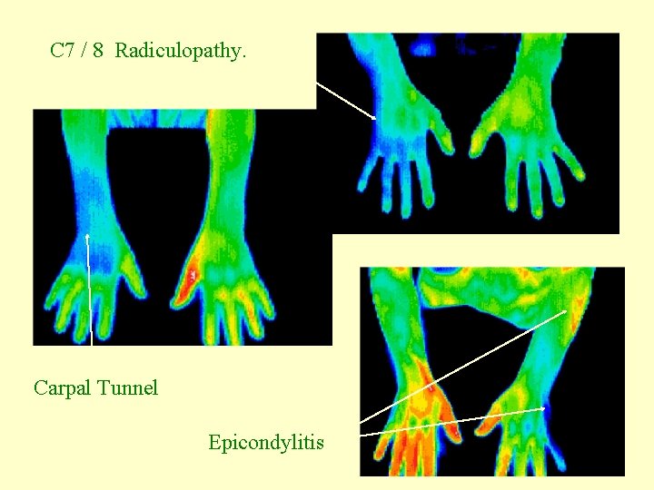 C 7 / 8 Radiculopathy. Carpal Tunnel Epicondylitis 