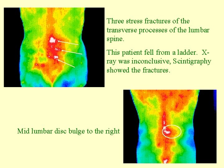 Three stress fractures of the transverse processes of the lumbar spine. This patient fell
