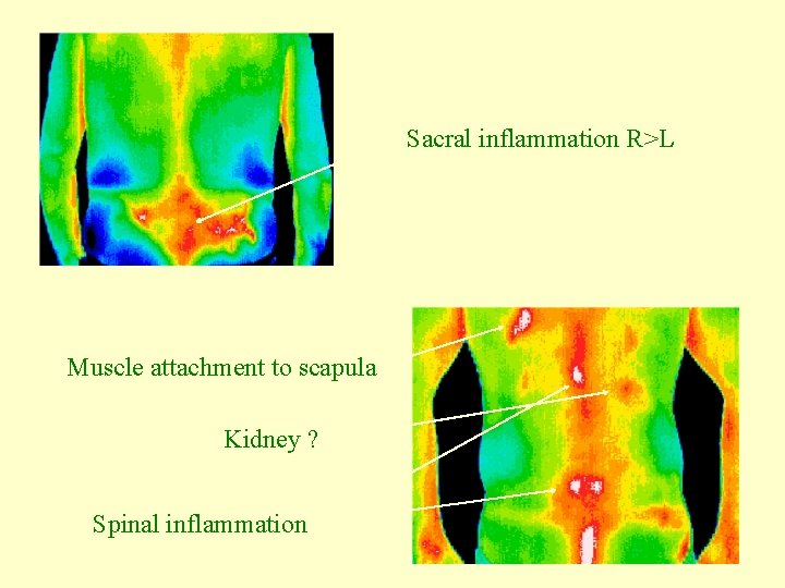 Sacral inflammation R>L Muscle attachment to scapula Kidney ? Spinal inflammation 