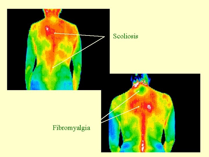 Scoliosis Fibromyalgia 