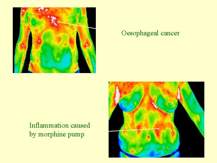 Oesophageal cancer Inflammation caused by morphine pump 