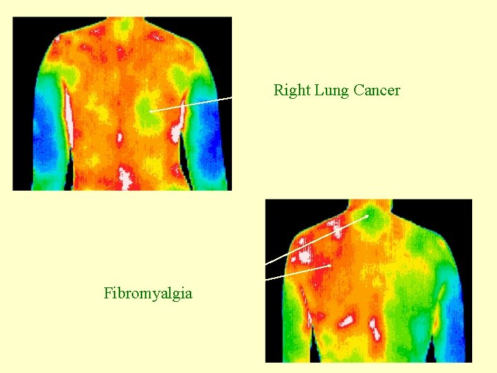 Right Lung Cancer Fibromyalgia 