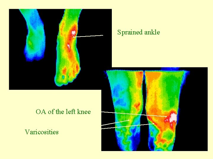 Sprained ankle OA of the left knee Varicosities 