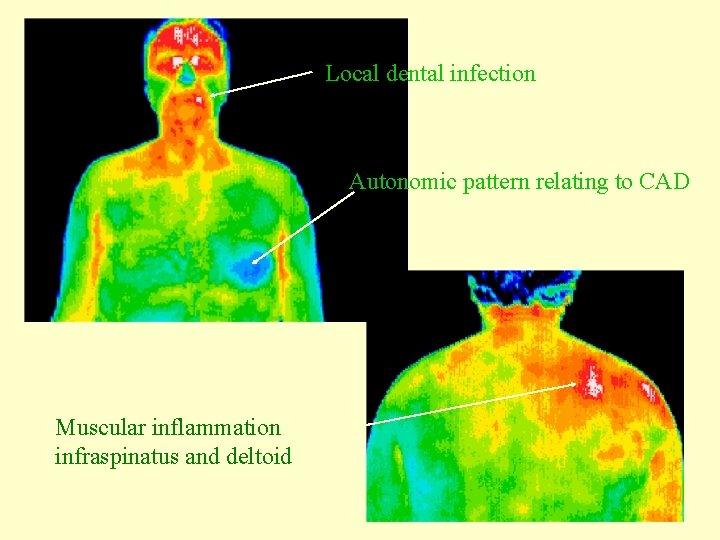 Local dental infection Autonomic pattern relating to CAD Muscular inflammation infraspinatus and deltoid 