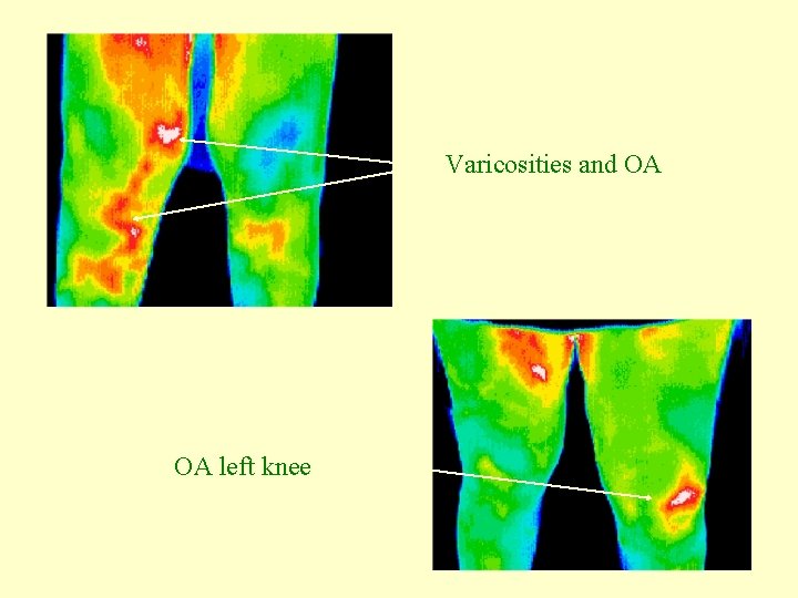 Varicosities and OA OA left knee 
