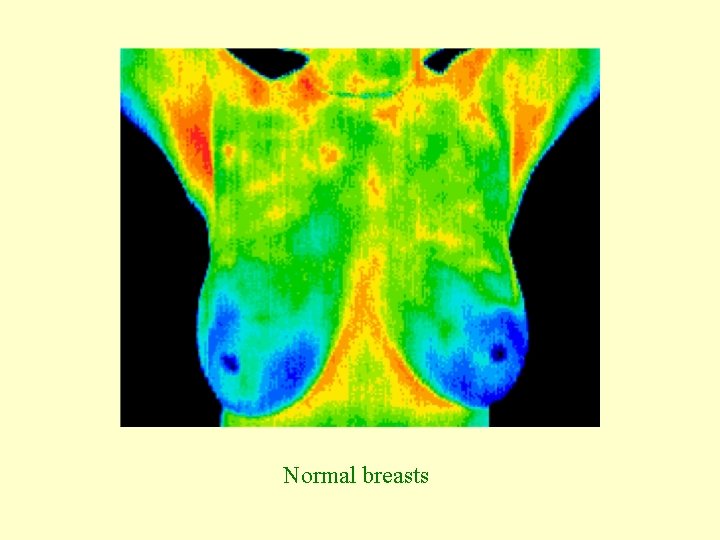 Normal breasts 