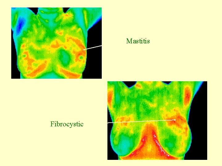 Mastitis Fibrocystic 