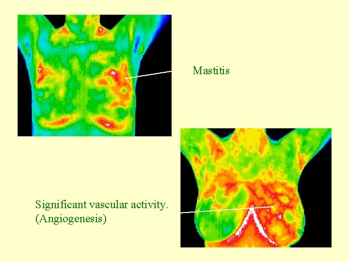 Mastitis Significant vascular activity. (Angiogenesis) 