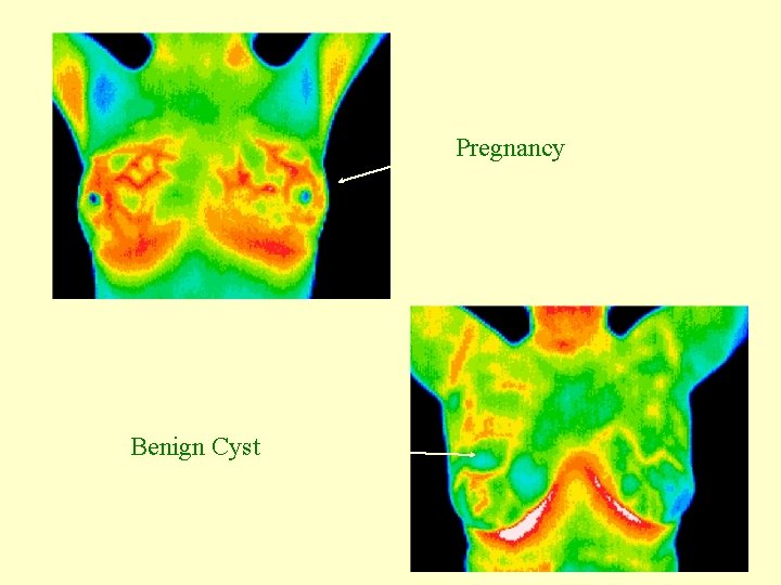 Pregnancy Benign Cyst 
