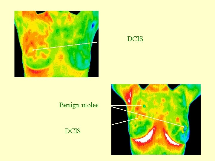 DCIS Benign moles DCIS 